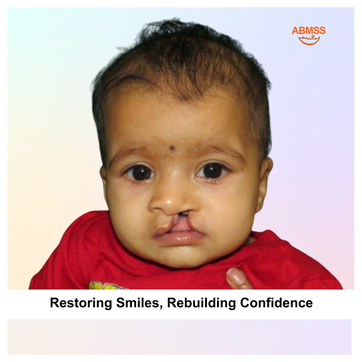 cleftindia's tweet photo. Children born with cleft lips or palates face many challenges, including difficulties with eating and breathing. But a simple surgery can restore their smiles and rebuild their confidence.
Join our mission to provide comprehensive care for these children!
#CleftIndia #ABMSS https://t.co/S3tPSDLrlO