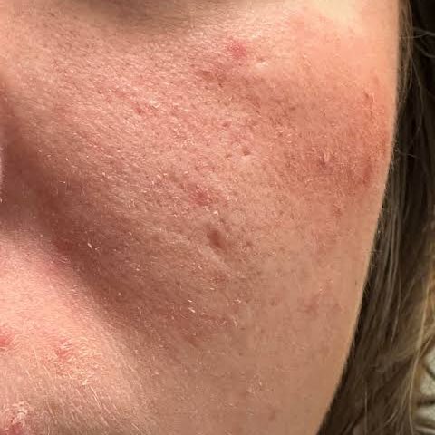 azeclair's tweet image. cuci muka itu kelihatan simpel, padahal bisa jadi biang kerok jerawat bandel😩

salah pilih facial wash → kulit jadi kering &amp;amp; ketarik