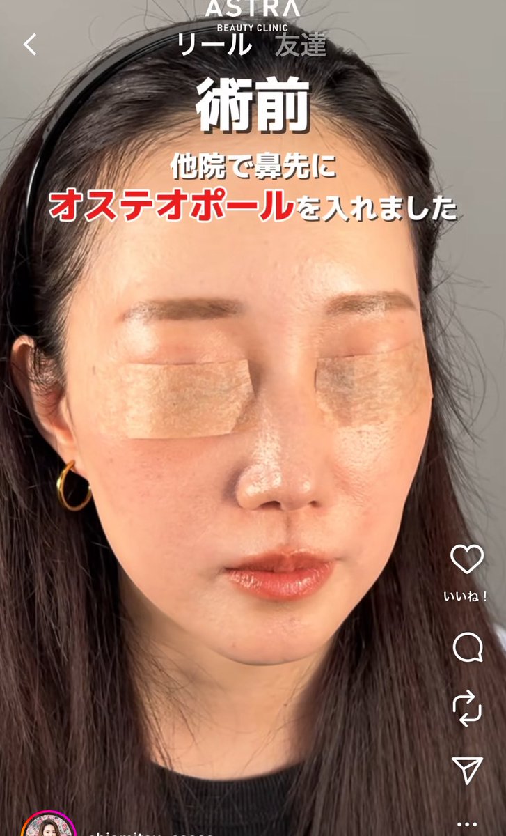 あなたが数年前まで患者に入れまくってたオステオでしょ？私はあなたに鼻筋メッシュを勧められて5本入れたけど。
手のひら返して意見変えて…
本当最低、サイコパス、無責任…