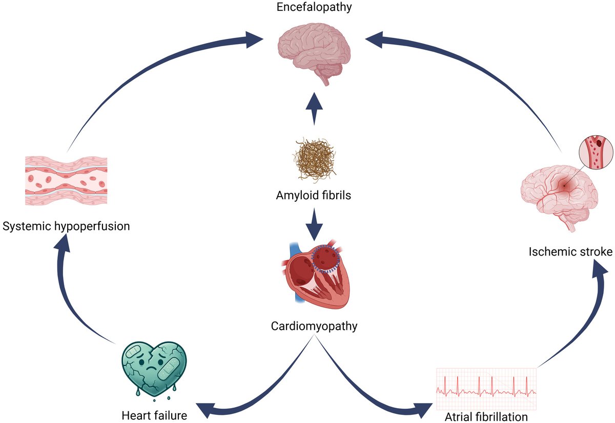 🛑NARRATIVE REVIEW~Wiley Online Library
Central nervous system involvement in cardiac amyloidosis: Redefining the heart‐brain axis
🔗 doi.org/10.1111/eci.70…
✍️🏻DomenicoMarioGiamundo  GiulianoCassataro  
StefanoMinistrini  SimonF.Stämpfli
<a href="/Ste_MNS/">Ste_MNS</a> 
@unitorvergatamed