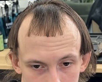 SarinGasFelon's tweet photo. UNCANNY!๐๐ง๐ปโ๐ฆฒ๐ชฎ #DefCon3 #recedinghairline #malepatternbaldness #grifter https://t.co/CKnTMDkEmS