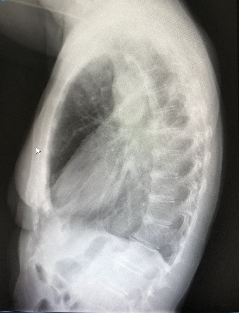 Mujer 64 años. #neumectomia der. por lesiones tuberculosas. #klinikabildo,#medtwiter