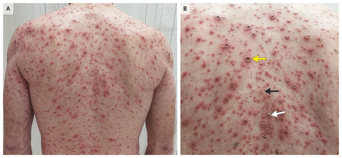 NEJM's tweet image. Images in Clinical Medicine: Primary Varicella Infection nej.md/3IonIVU 

#DermTwitter