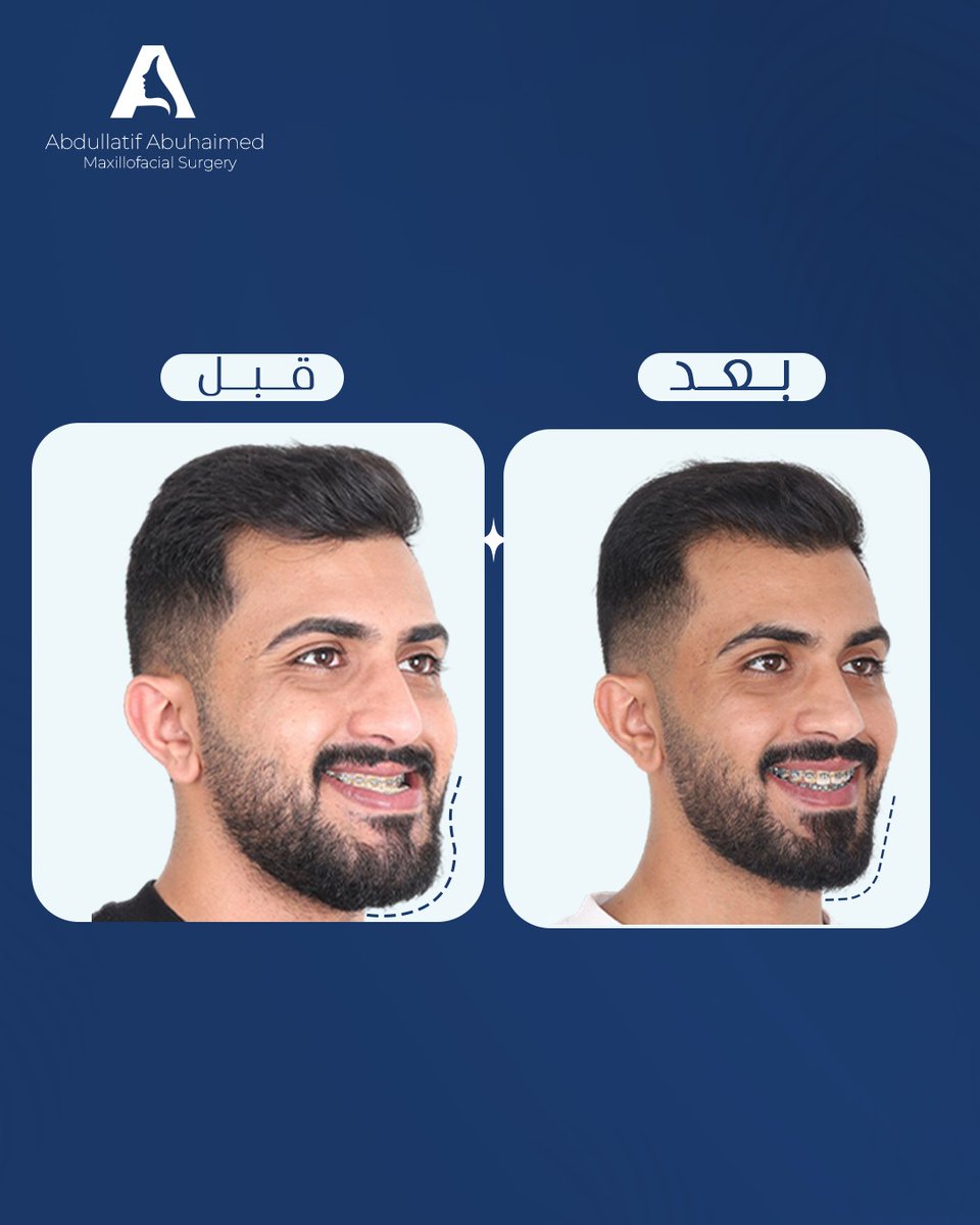 جراحة وتصحيح الفكين لتعديل تقدم الفك السفلي وتراجع الفك العلوي 

للاستشارات الطبية المتخصصة و الحجز 
عن طريق رقم التنسيق 📞 : +966552474730 
د. عبداللطيف أبوحيمد 🧑‍⚕️
استشاري جراحة الوجه والفكين
#BeyondBalance

#الصحة #الصحة_العامة #الوجه #الفكين #الرياض #الاطباء