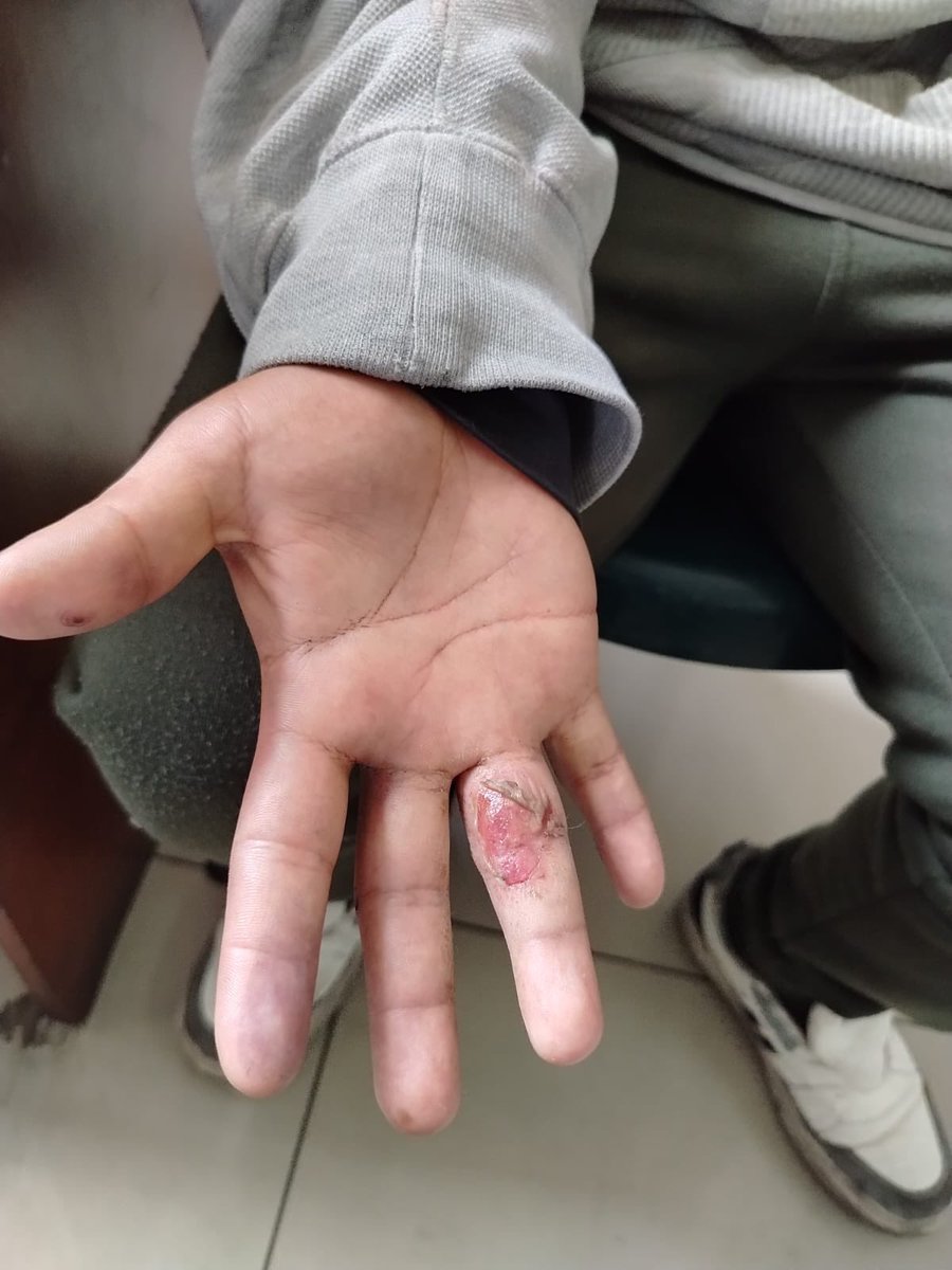 mirecarhuas's tweet image. #Urgente Samuel tiene infectado el dedo luego que le cayera perdigones en la marcha del 20 set. La policía lo tiene secuestrado en Asuntos Sociales por defenderse de violencia constante que sufre por parte de la PNP del régimen de Keiko-Boluarte
Liberen a Samuel
#PerúEnDictadura