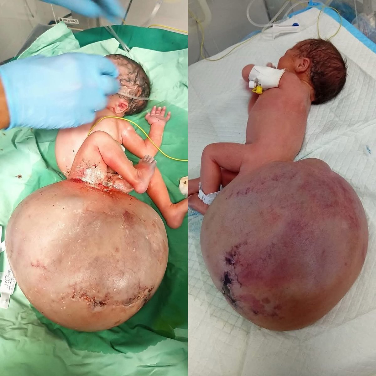 She was born yesterday at alShifa Hospital in Gaza City with a rare congenital anomaly a large tumor in the coccyx area medically known as Sacrococcygeal Teratoma Her mother had been exposed during the war to toxic gases the smellof gunpowder and smoke in addition to contaminated