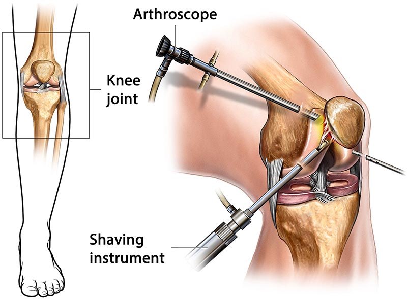 Gavi had an “arthroscopy” to resolve a medial meniscus injury.

I will explain,
- Arthroscopy is a minimally invasive knee surgery where the surgeon uses a tiny camera (arthroscope) and small instruments inserted through small incisions.

It allows them to look inside the knee