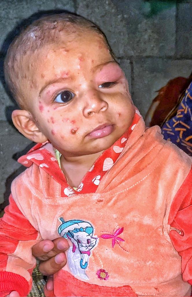 I beg you, don't bully me. Tasneem's eyes are swollen and puffy, and she is crying bitterly from a serious skin condition. Her body is covered in pimples, and blisters are spreading rapidly on her face, worsening with the heat of the tent and causing severe burning, severe pain,