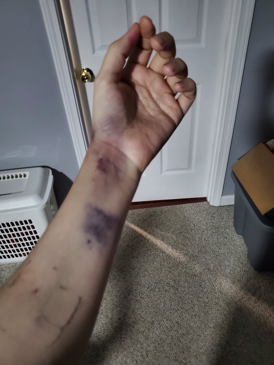 6 hours of surgery took a massive toll on me,finally home after 5 full days. These are only a few, there a are lot more photos I need to enter into my story.

Healing is taking forever, but I will be back to breaking down darker news again shortly.

#Crohnsy #dark2light #Maga 🙏