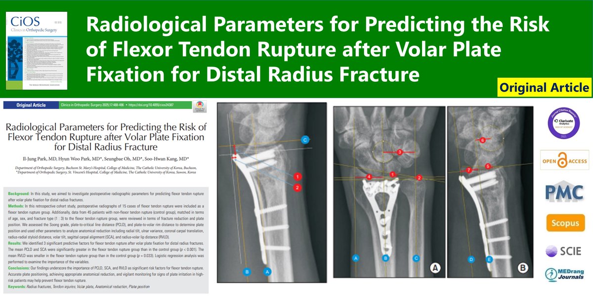 CiOSjournal's tweet image. Radiological Parameters for Predicting the Risk of Flexor Tendon Rupture after Volar Plate Fixation for Distal Radius Fracture
🌷doi.org/10.4055/cios24…
2025 Jun;17(3) Il-Jung Park
#Radius_fractures #Tendon_injuries #Volar_plate #Anatomical_reduction #Plate_position