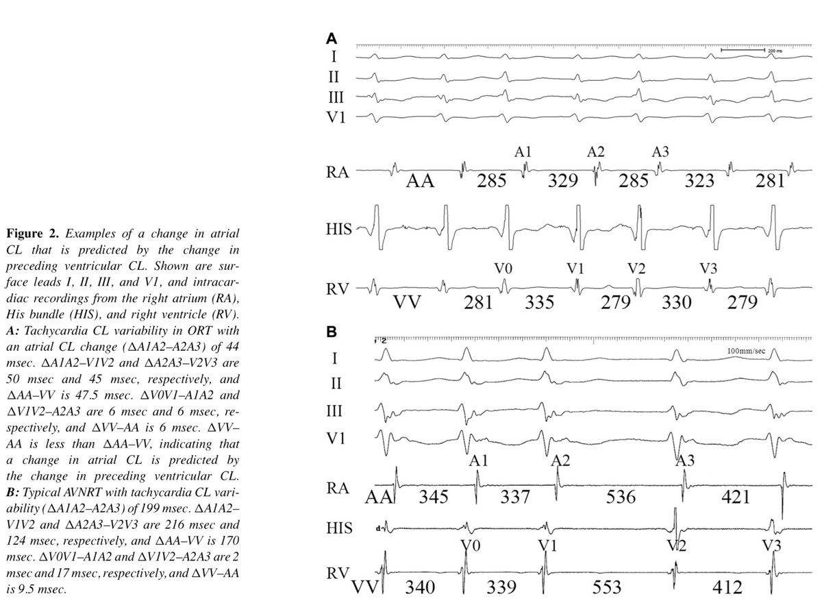 Narrow QRS tachycardia で頻拍周期に揺らぎがあった場合
RR間隔の変化がPP間隔の変化に先行していれば
➡️ORT又はTypical AVNRTの可能性が高い
PP間隔の変化がRR間隔の変化に先行していれば
➡️AT又はAtypical AVNRT の可能性が高い
deepblue.lib.umich.edu/bitstream/hand…