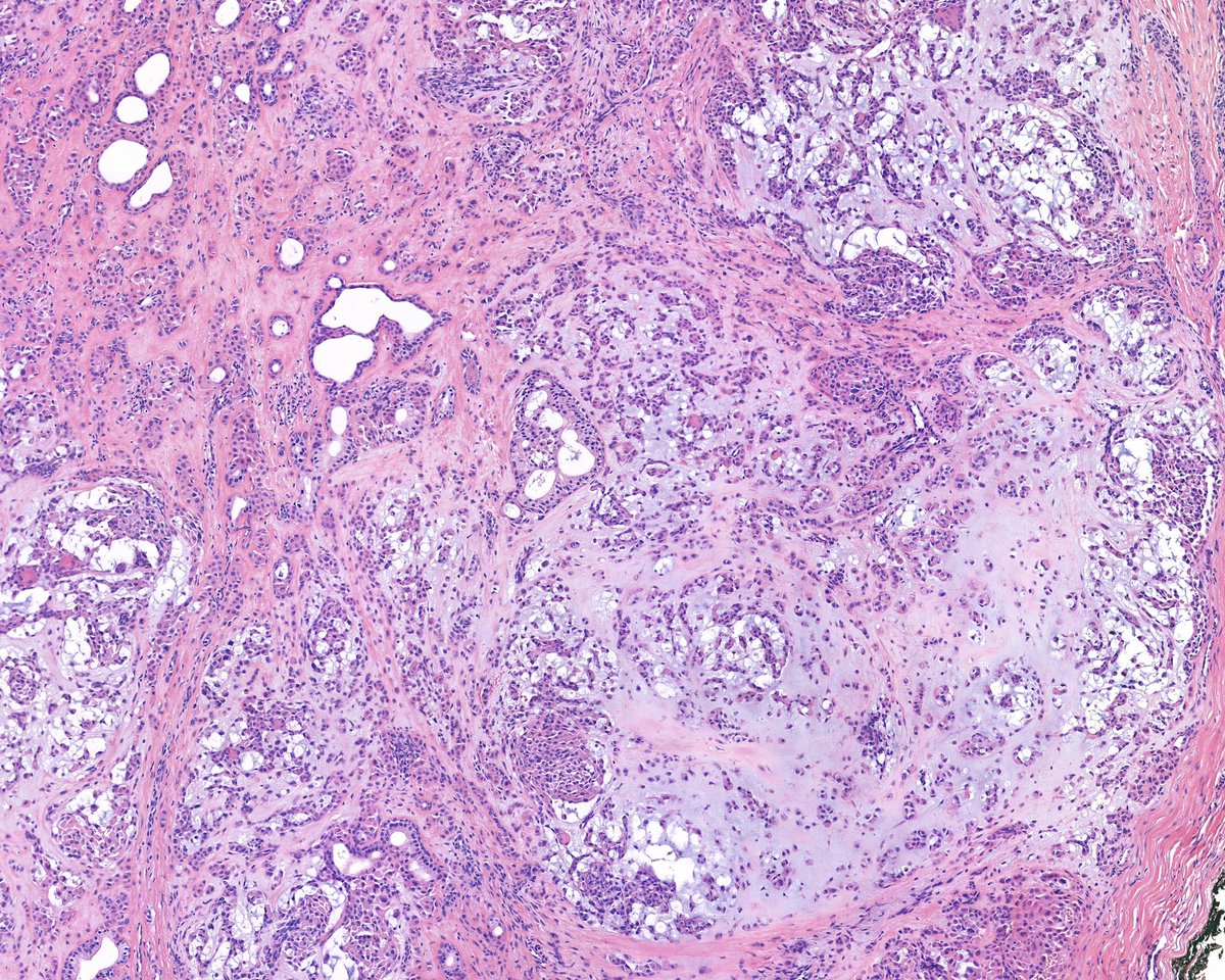 Foot, 30y

#pathology #patologia #pathoutpic #bstpath #dermpath