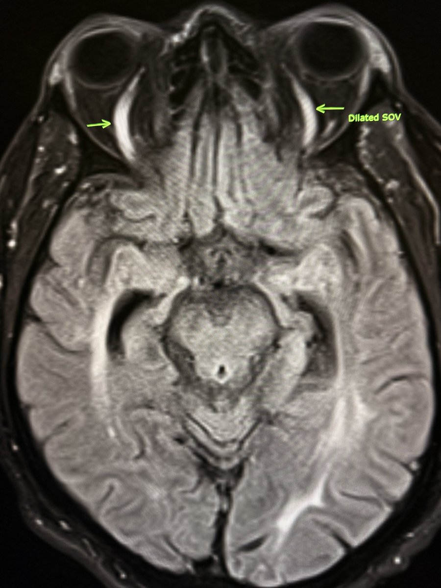 Pearl: 
Dilated superior ophthalmic veins can be seen in intubated ICU patients due to raised intrathoracic pressure and venous congestion.

Pitfall: 
Don’t overcall it cavernous sinus thrombosis. Bilateral, symmetric dilation without orbital congestion is usually benign.