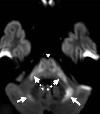 “Not every panda in Wilson’s disease is friendly 🐼.
Sometimes, diffusion restriction sneaks in — a subtle but serious clue of severe disease.
Fresh insights from Garg et al., Ann Indian Acad Neurol (2025) 👉 doi:10.4103/aian.aian_483_25"