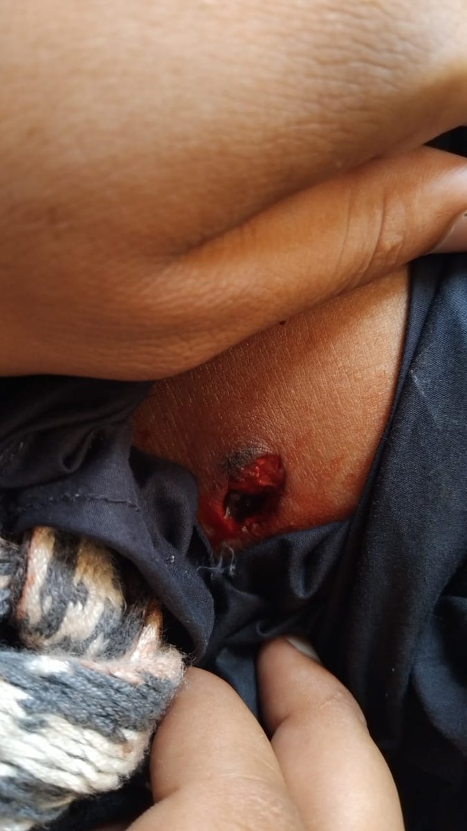 rahman_murad8's tweet photo. A student has been injured by bullets fired by security forces. Universities are meant for knowledge &amp; progress, yet we are facing bullets and crackdowns. This violence against students is unacceptable and condemnable.
#SaveBalochStudents
#StopHarrasingBalochStudents https://t.co/CkdOnK67Uj