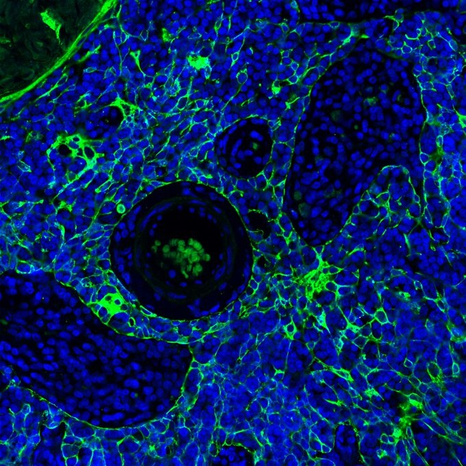 📅 Hoy es el Día Mundial de la Investigación en #Cáncer, una jornada para visibilizar la ciencia frente a este conjunto de enfermedades 

🔬 Te contamos algunas de las investigaciones oncológicas del #CSIC para mejorar la salud de las personas

#WorldCancerResearchDay 🧵👇