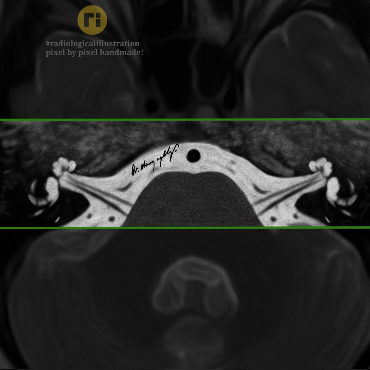 Banding Artifacts 

#radiologicalillustration ✍️
pixel by pixel handmade!