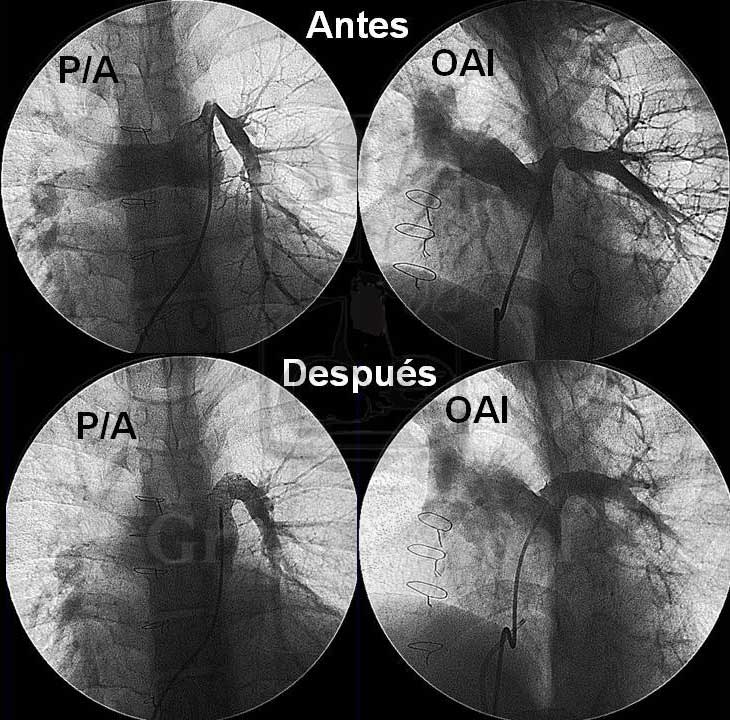 🏥 #casoclinico 

👦Implante de stents en estenosis de rama pulmonar izquierda en paciente de 8 años 

Caso completo ⬇️ grupocorpal.com/implante-de-st…
#cardiologia #cardiopatiascongenitas #CIV #estenosis