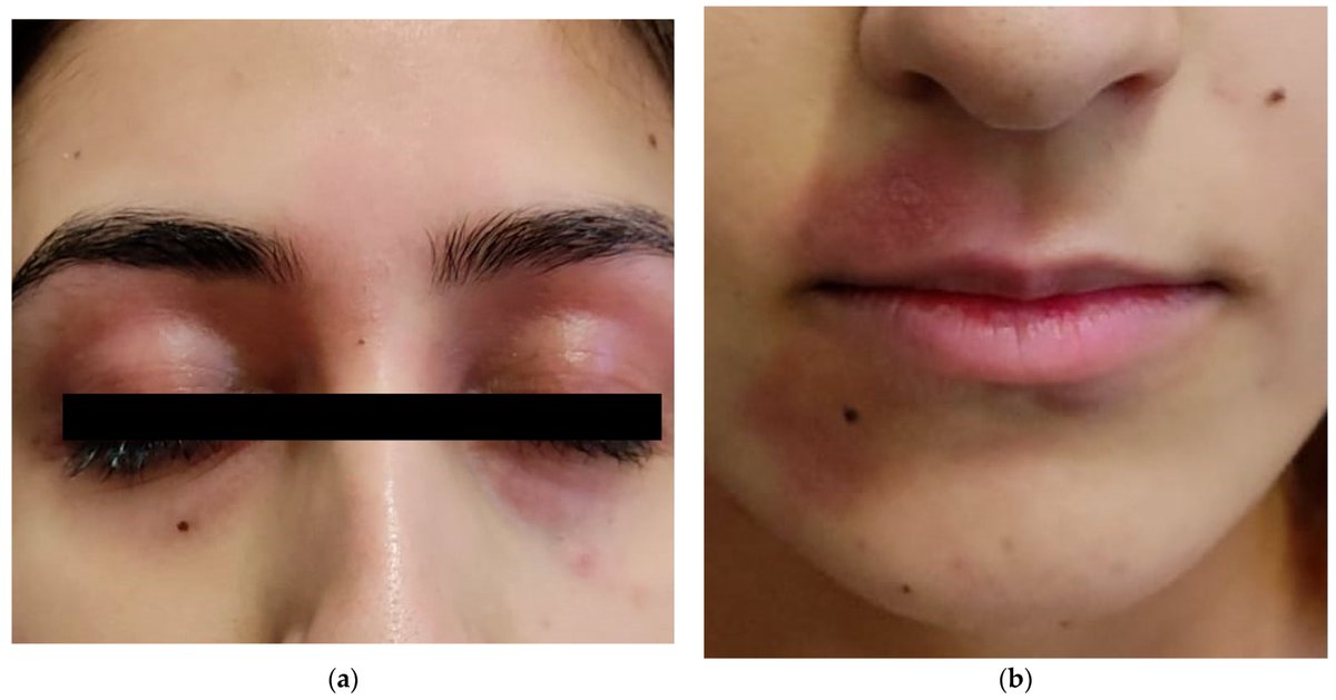 🔔#Allergies_MDPI Welcomes you to read our publication "Retrospective Study on Acute Effects of Mount #Etna Volcanic Eruption in #Patients with Atopic #Dermatitis" by Dr. Federica Trovato et al.

✅Link: brnw.ch/21wW39l

#Vasculitis #MDPI