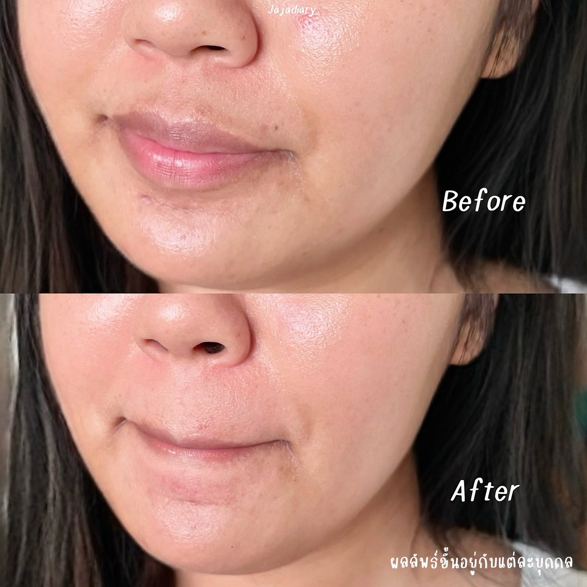 jajadiary's tweet photo. เป็นเซรั่มลดรอยดำที่ชอบมากจริงๆ Eucerin Booster Serum ขวดที่สองที่เราใช้แล้ว คือเรามีรอยดำจากรอยสิวอยู่แล้ว ใช้ตัวนี้แล้วจางลงจริงๆ พวกฝ้าบางๆที่หน้าแก้มก็ดีขึ้น เชื่อใ���ไทอามิดอลของเค้าอ่ะ สารไบรท์เทนนิ่งตัวเก่งของยูเซอริน ช่วยลดฝ้า และพวกจุดดำเก่งมาก เก่งถึงสามารถจัดการจุดที่ฝังลึกใต้ผิวที่มองไม่เห็นเลย ยิ่งพอได้ลองใช้คู่กับน้ำตบ คือเลิฟมาก เราใช้คู่กันมาสักพัก ฝ้ามันจางไว แถมผิวอิ่มฟู หน้าไบรท์เร็วขึ้นมาก ดีขึ้นจริงๆ ใครที่มีงบหน่อยแนะนำคู่นี้เลยย #ใช้ดีบอกต่อ