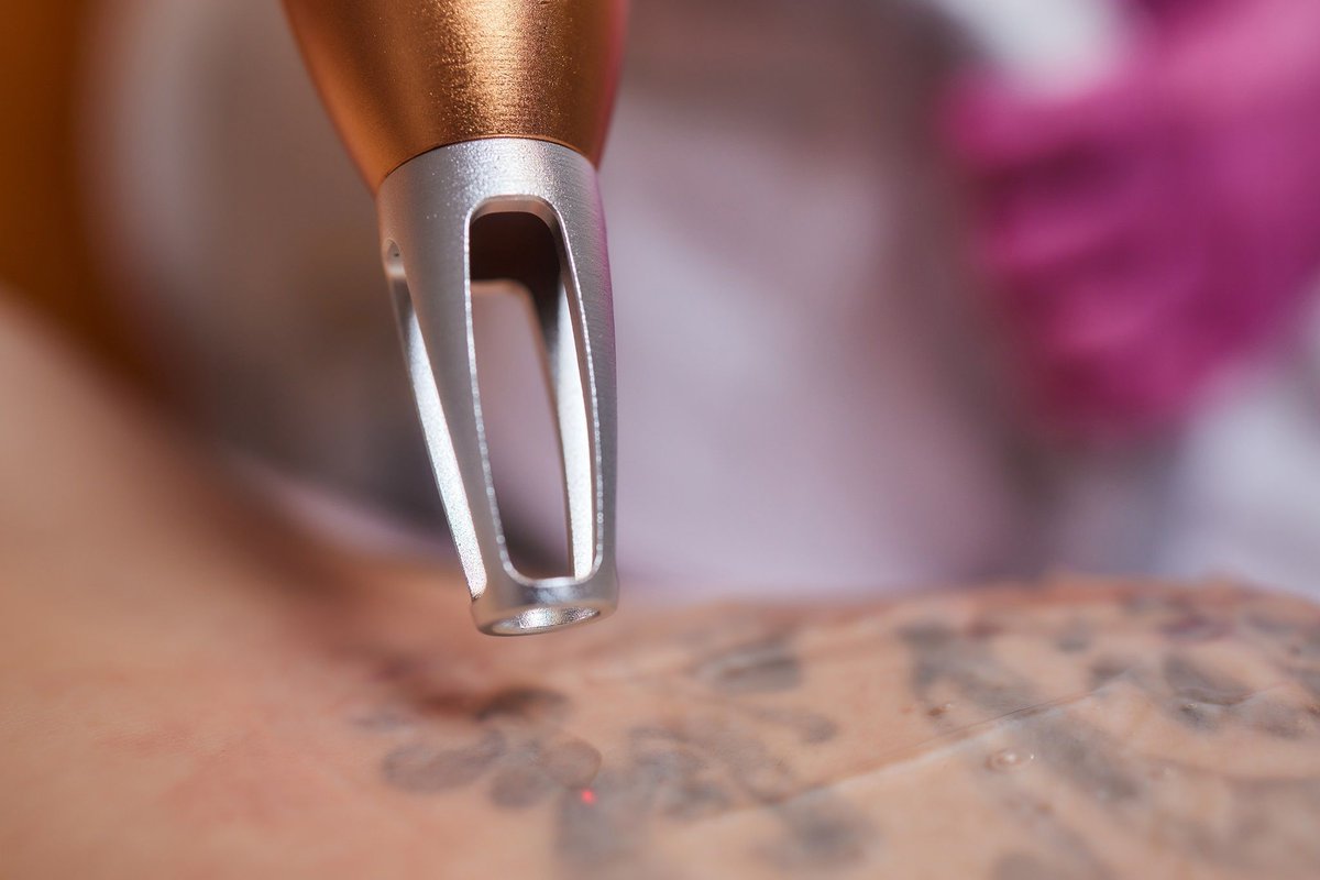 SkinDeepLaserVA's tweet photo. Thinking about removing an unwanted tattoo? Fall is the perfect time! Less sun, easier healing, and results ready by summer. Learn why autumn is ideal for safe, effective tattoo removal with Skin Deep Laser Services. #TattooRemoval https://t.co/OwcEFeK0uc https://t.co/2QGntpYian