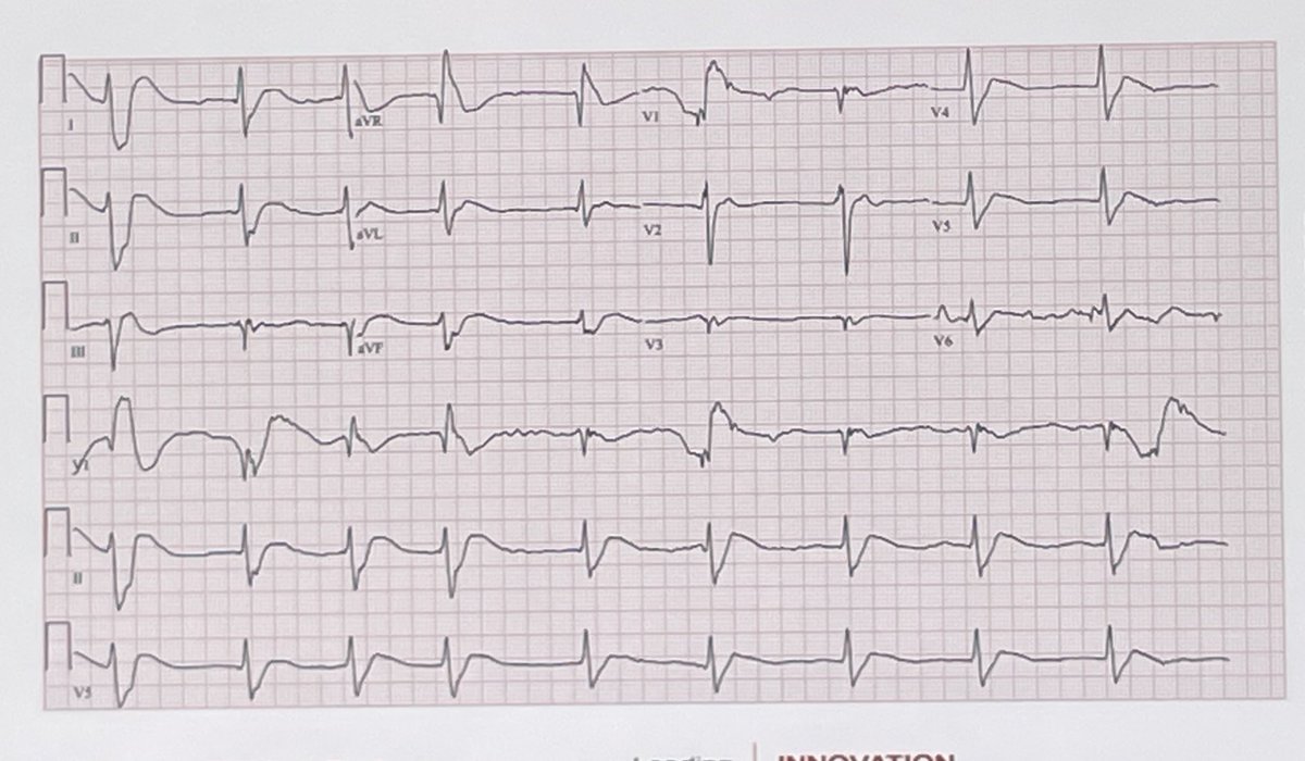 #ALLNYCEM25
Dr. Brenna Farmer presents the case of the obtunded overdose round 2!

This time we know it’s from Benadryl and get an EKG: