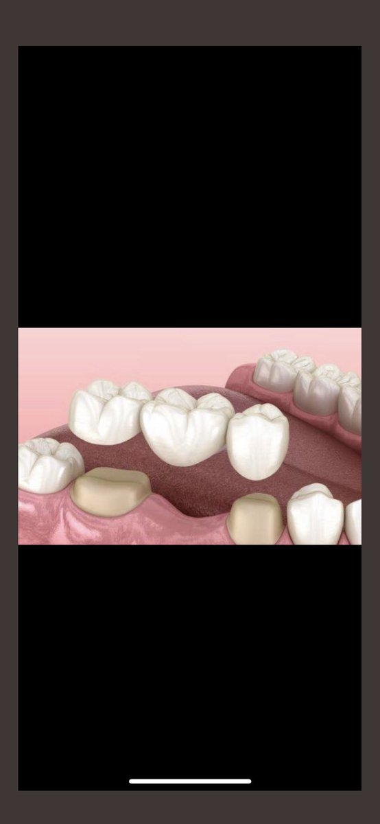 GigiKoas's tweet photo. GIGI PALSU GRATIS 🤑🦷
Bagi yang punya keluhan gigi graham bawah kanan hilang atau gigi depan atas hilang dan ingin digantikan dengan gigi palsu cekat (tidak dilepas pasang) seperti foto dibawah, boleh dm yaa
📌Jakpus
#koasgigijakarta #gigipalsugratis #koasgigijakartapusat https://t.co/ORysNb0DJj