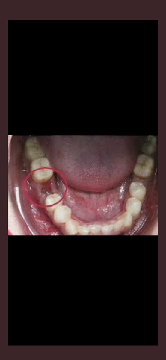 GigiKoas's tweet photo. GIGI PALSU GRATIS 🤑🦷
Bagi yang punya keluhan gigi graham bawah kanan hilang atau gigi depan atas hilang dan ingin digantikan dengan gigi palsu cekat (tidak dilepas pasang) seperti foto dibawah, boleh dm yaa
📌Jakpus
#koasgigijakarta #gigipalsugratis #koasgigijakartapusat https://t.co/ORysNb0DJj