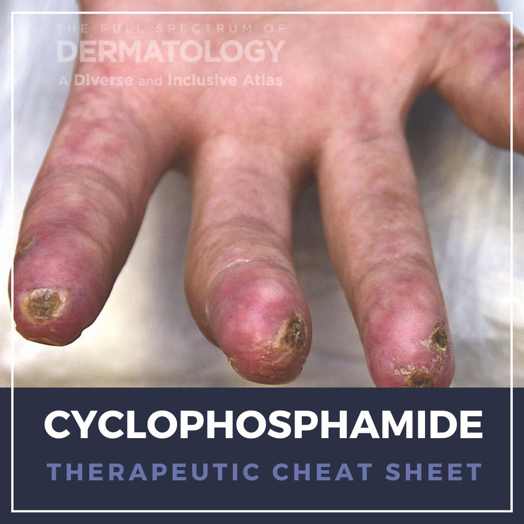 Cyclophosphamide remains a rescue option for severe autoimmune skin disease (pemphigus, dermatomyositis, lupus, vasculitis) despite safer alternatives. Check out this month's Therapeutic Cheat Sheet by GW Resident R. Picavia: ow.ly/U6Y050X1xPy