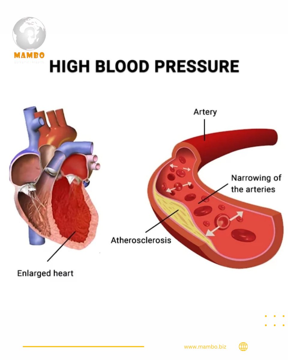 THE SILENT KILLER: HIGH BLOOD PRESSURE IS ON THE RISE 🌐

The World Health Organization #WHO reports that 1.4 billion people around the globe ail from high blood pressure #HBP, also referred to as the ‘silent killer’.

WHO Director-General, Dr. Tedros Adhanom Ghebreyesus said it