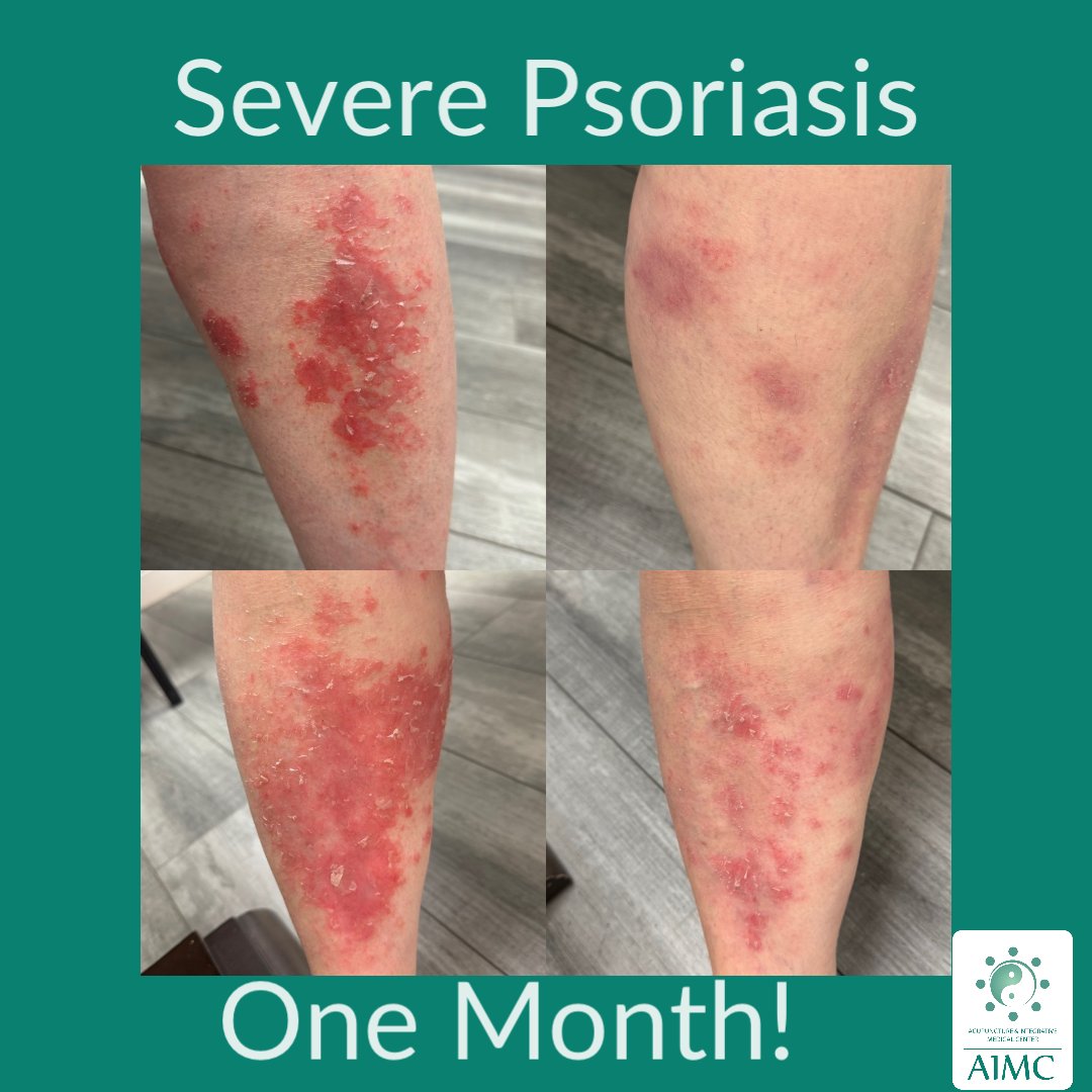 ChapaOmd's tweet photo. Know anyone with #psoriasis ? No steroids, No needles, only 100% natural, safe herbs from S. Korea! This patient is much better in one month. #drchapa #aimc #acupuncture #koreanmedicine #herbalmedicine #holisticmedicine #한의사 https://t.co/9UPSkraDPb