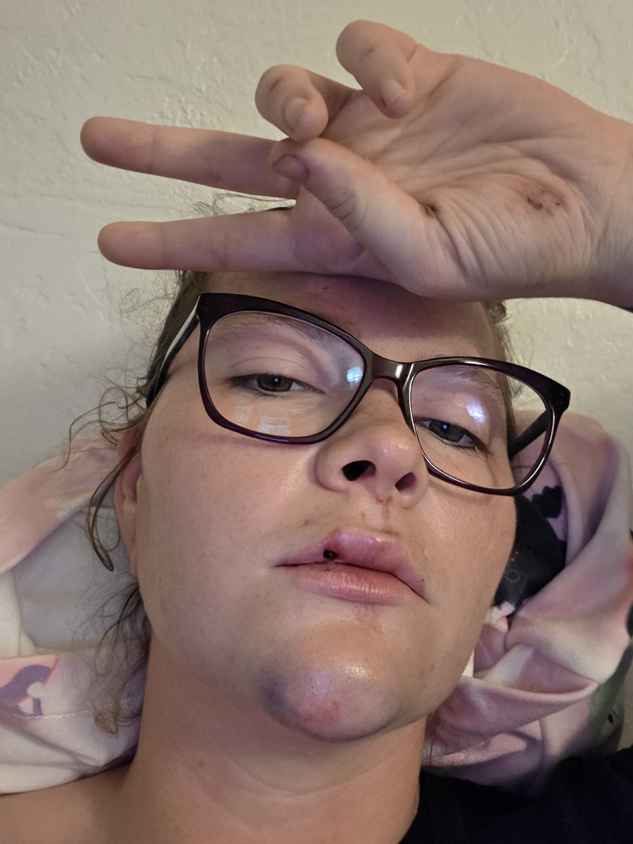 BubatzBea's tweet photo. Guess who can now accurately say when it feels like they've been hit by a car?

You think you can stop me? So did that car. I am so glad to be alive but I really do not recommend this experience to anyone. Be safe out there https://t.co/SXdvp0J9Gz