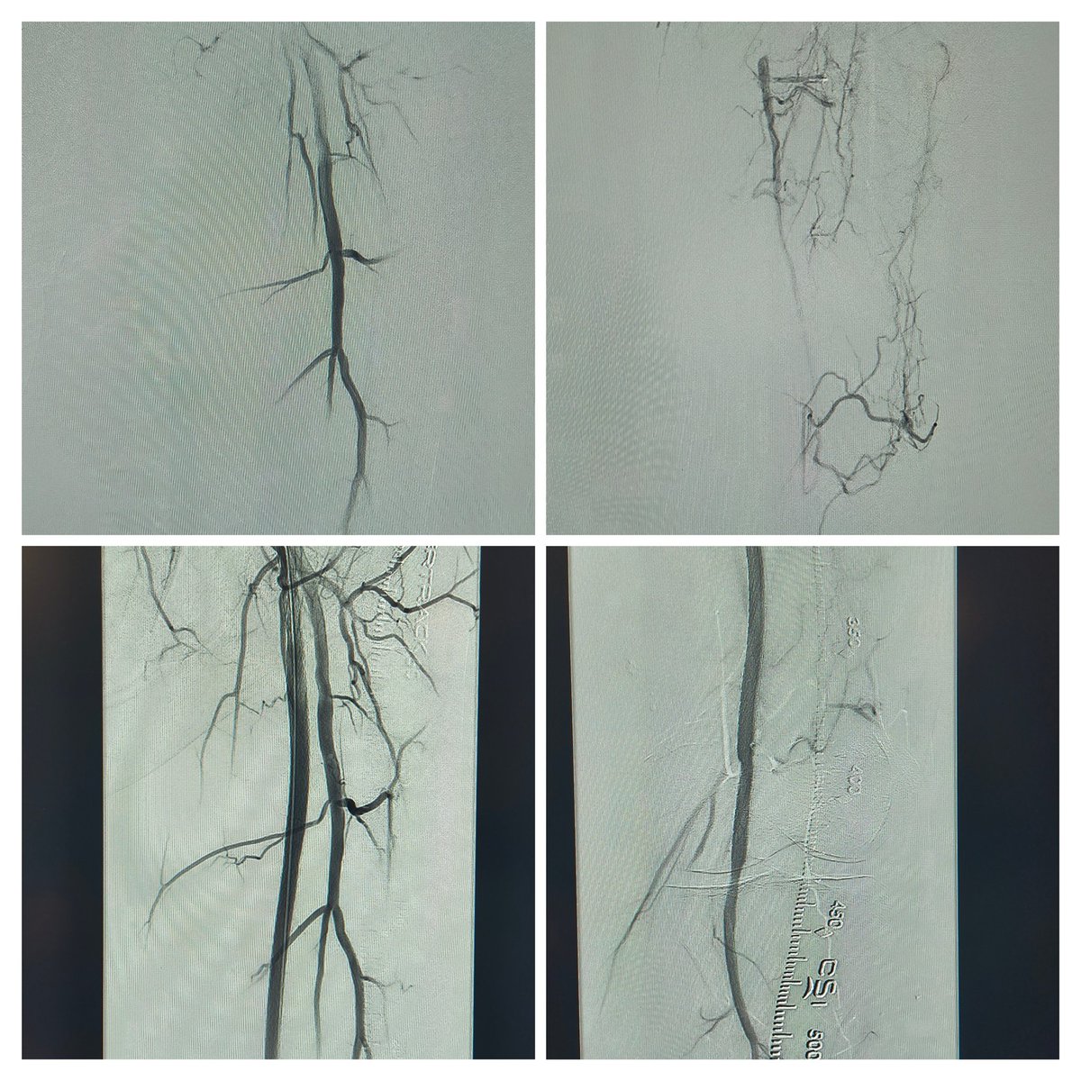 #PTAB doesn’t have to be long or complicated. Once you’ve done a few, sub-1 hour cases are the norm. Wrapped one up today in just 38 minutes <a href="/Phantom495/">Phantom495</a> <a href="/MarcoShakerIC/">Marco Shaker</a> <a href="/DeanFerreraDO/">Dean Ferrera</a> <a href="/JodiWeinzetl1/">Jodi Weinzetl</a> <a href="/endologix/">Endologix</a>