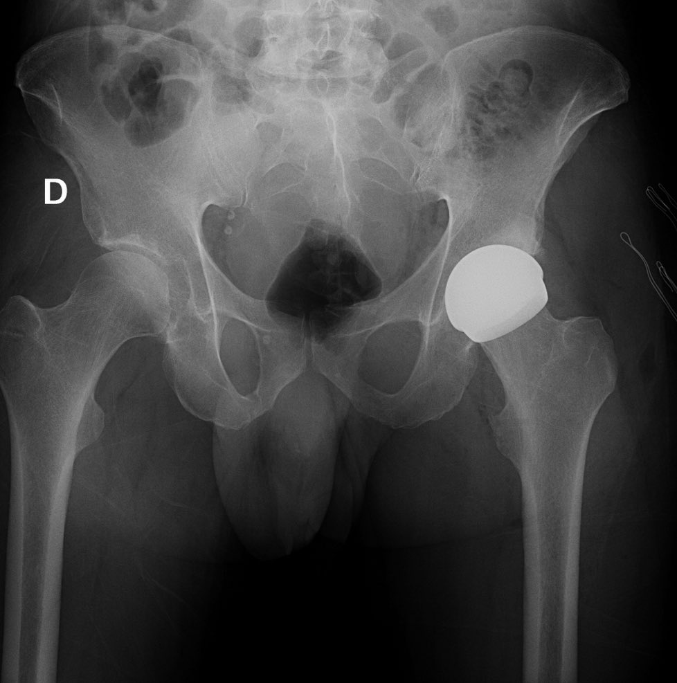 Resurfacing cerámica-cerámica. 2º caso de la semana: varón de 45 años muy deportista.
Será un cambio del paradigma en el tratamiento de los pacientes jóvenes con artrosis más activos y exigentes.