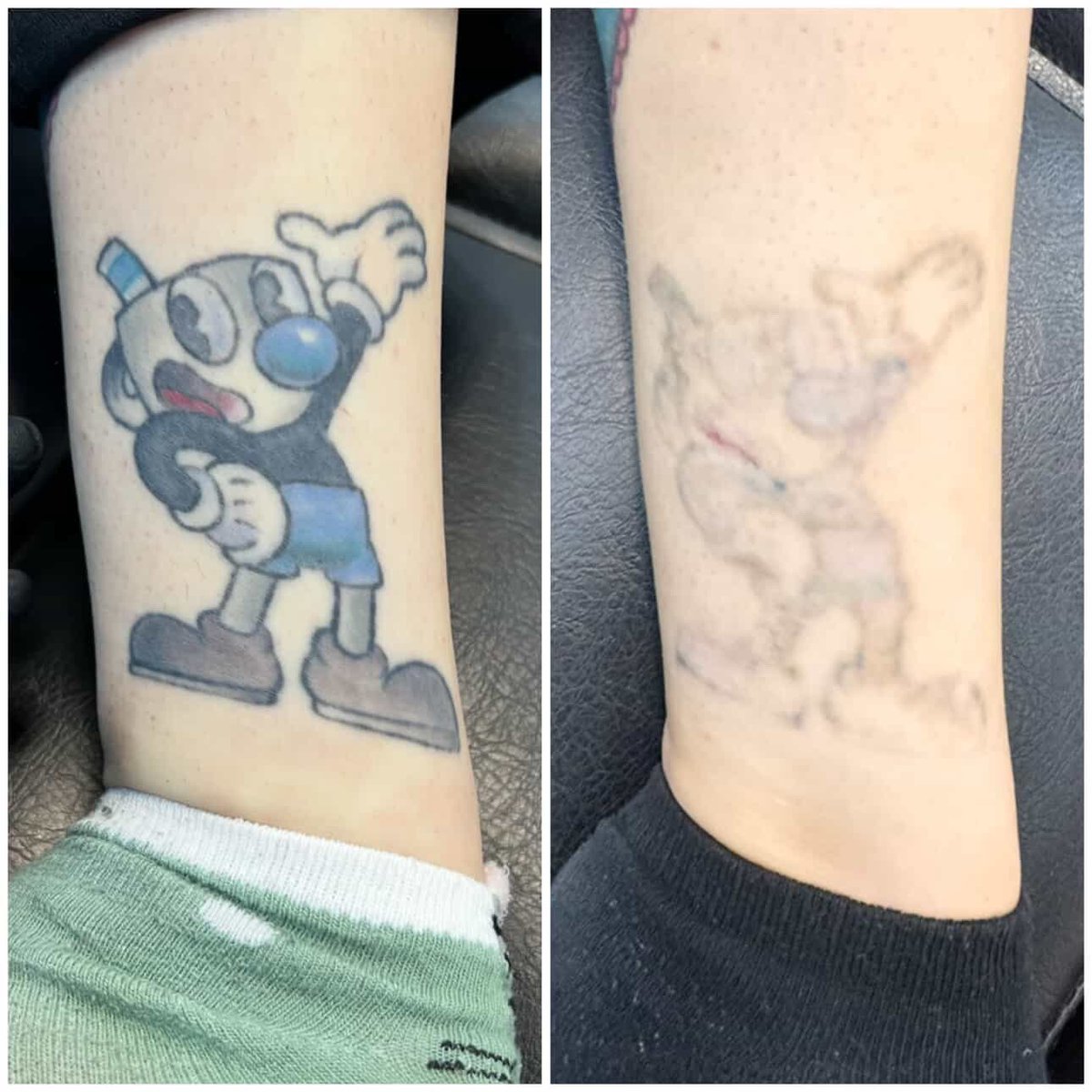 Hoy hace dos años empecé a quitarme este hijueputa tatuaje.

Que proceso tan doloroso pero tan satisfactorio ha sido 🩷

(Si mi piel así lo quiere, hoy fue mi última sesión 🥹❤️‍🩹)