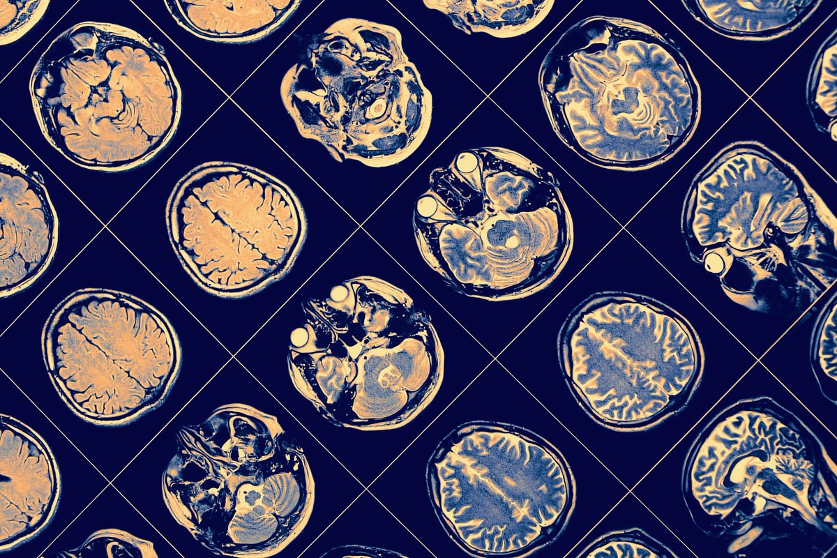 NewsMedical's tweet image. Blood and brain biomarkers are changing Alzheimer’s diagnosis, making it faster, more accurate, and fairer for everyone. 🧠✨  news-medical.net/news/20250924/… #Alzheimers #Biomarkers @TheLancet