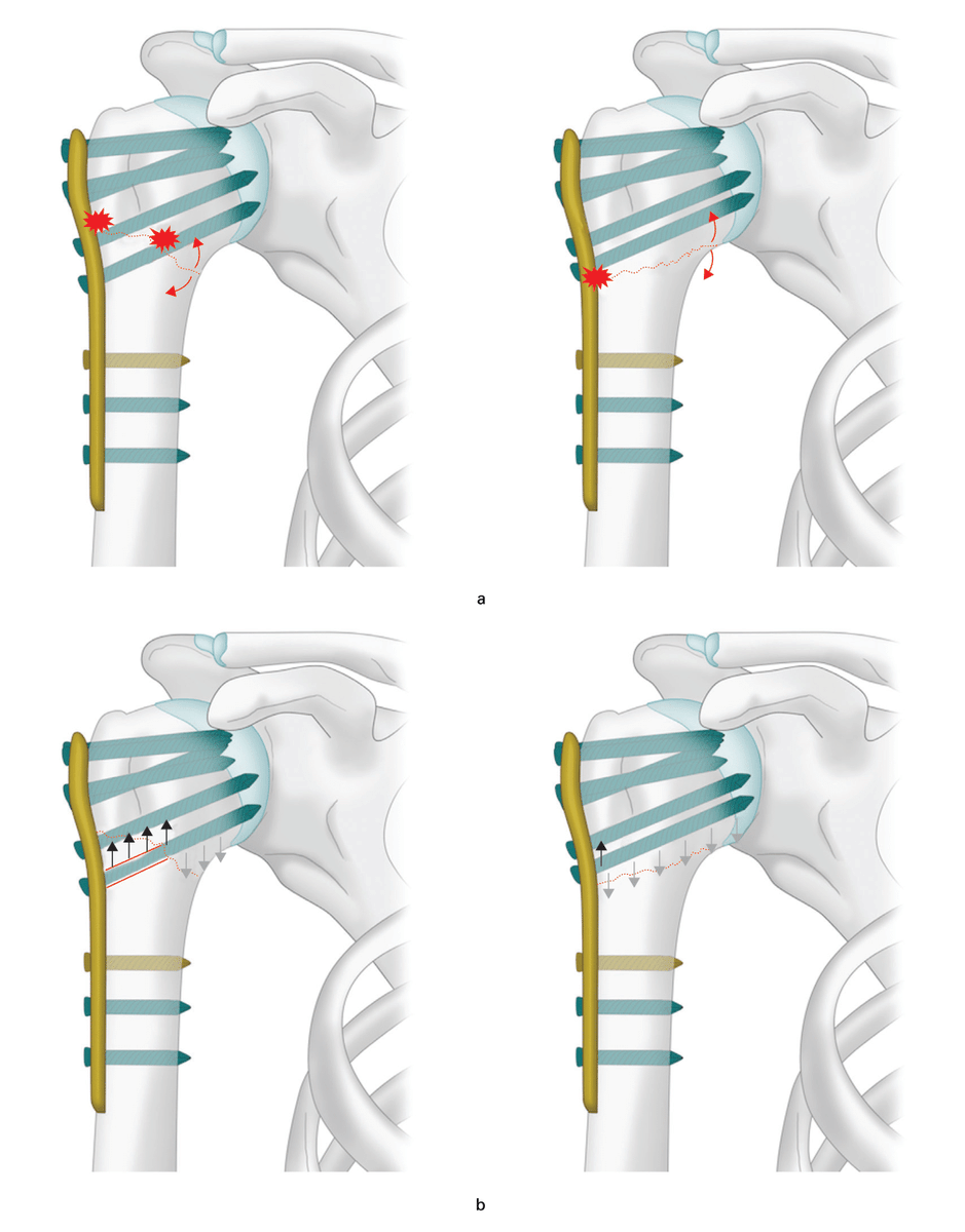 BoneJointJ's tweet photo. The trajectory of the calcar screw, specifically whether it intersects the fracture line and engages both proximal and distal fragments, significantly influences the risk of fixation failure in proximal humeral fractures.

#Fracture #Surgery #Orthopedics 

https://t.co/ErEBAie5Vb https://t.co/hC40TkffVr