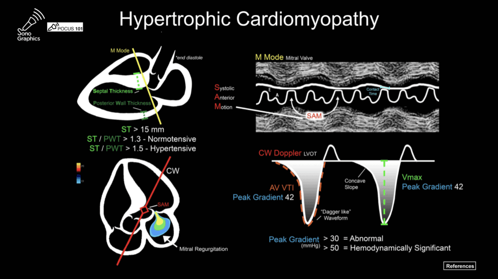 HOCM Echo Infographic 

Check: MR ASH SAM
1. MR: Mitral regurgitation 
2. ASH: Asymmetrical septal hypertrophy 
3. SAM: Systolic anterior motion of AML
4. Peak gradient across LVOT