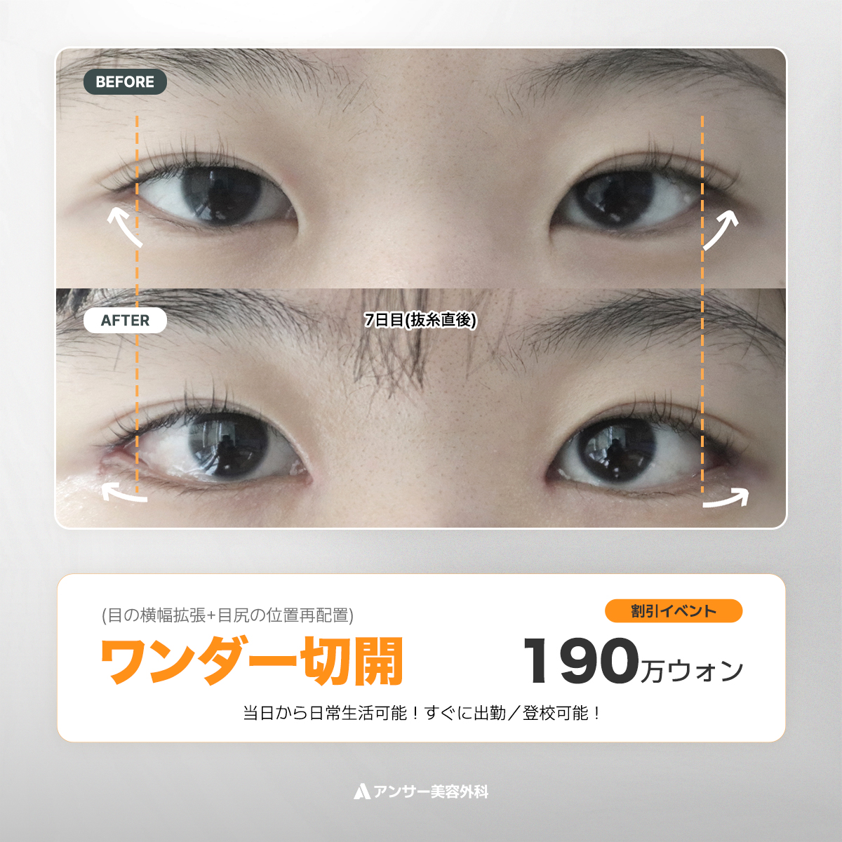 answerpsjp's tweet photo. 🔥アンサー特別価格イベント🔥
👀ワンダー切開（目の横幅拡大＋目尻の位置変更）→　190万ウォン
（✨一番人気な施術、効果も最大✨）

目頭切開　90万ウォン
目上切開　90万ウォン
タレ目切開　170万ウォン
埋没二重整形　120万ウォン
切開二重整形　260万ウォン
目の下脂肪再配置　260万ウォン

👉単独での施術ではなく、ワンダー切開を同時に行った場合に適用される特別価格です。

韓国No.1目整形専門のアンサー美容外科
👀アンサー美容外科だけのワンダー切開
→手術当日から日常生活可能✨
#韓国美容外科 #韓国目整形　#目　#目整形　#当日から日常生活　
#自然な目整形　#ワンダー切開　#二重整形　#目頭切開　#目尻切開　#垂れ目形成

📩お問い合わせはLINEまで|🗣️日本語通訳常駐
🔗LINE: 
@answerjp

📍江南駅12番出口, テヘラン路105 B Aタワー6階(徒歩1分)