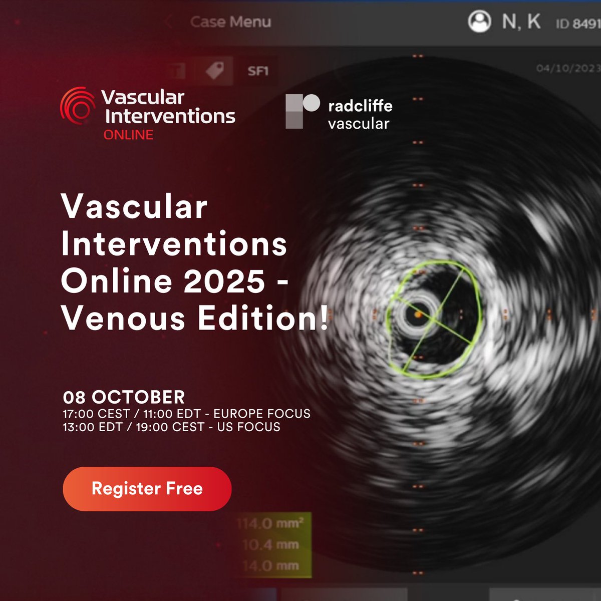 Join us at Vascular Interventions Online 2025 – Venous Edition on 8 October! 

ow.ly/tUhP50X1XP4