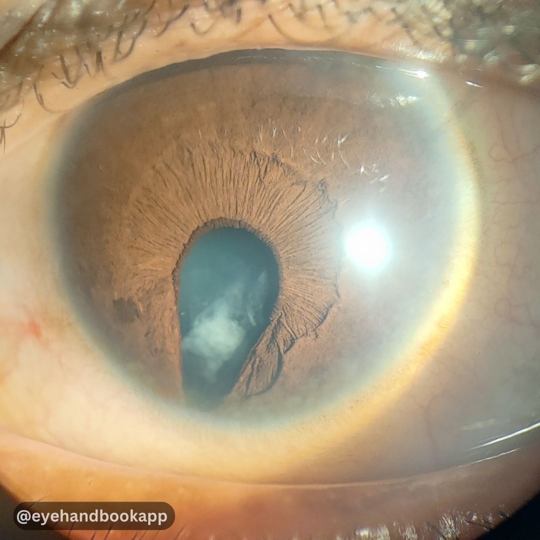EyeHandbook's tweet image. How would you manage this?

#eyes #AnteriorSegment #cornea #clinicalcalculators #eyecalculators #eyeatlas #ophthalmologist #optometrist #eyedoctors #ophthalmology #optometry #cornea #ophthalmologyresident #retina #optometryresident #ophthalmologyapp #oftalmologia #eyesight