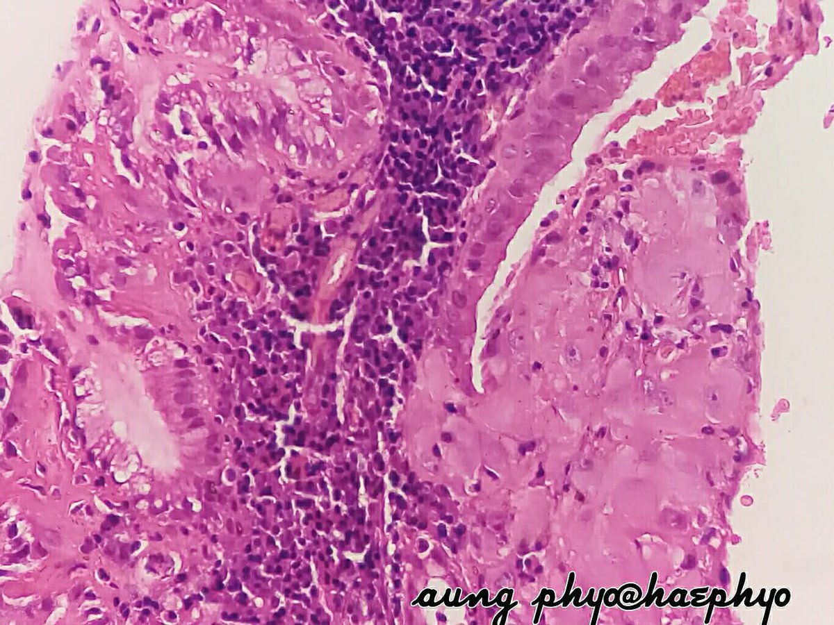 pathphyo's tweet photo. Female, 34 week pregnancy with cervical growth. Clinically suspected Ca cervix. Colposcopy and biopsy done.
A case of cervical decidual nodule. https://t.co/XZYGGDm82A