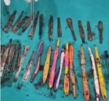 29 spoons and 19 toothbrushes recovered from the stomach