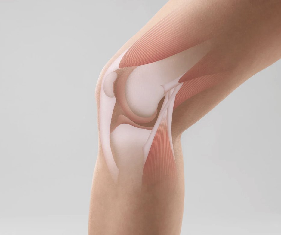 The purpose of this study is to evaluate the postoperative outcomes and failure rates of the all-inside versus inside-out suture techniques in meniscal repairs among athletes. medilink.us/sdl3 #medtwitter #meniscustear