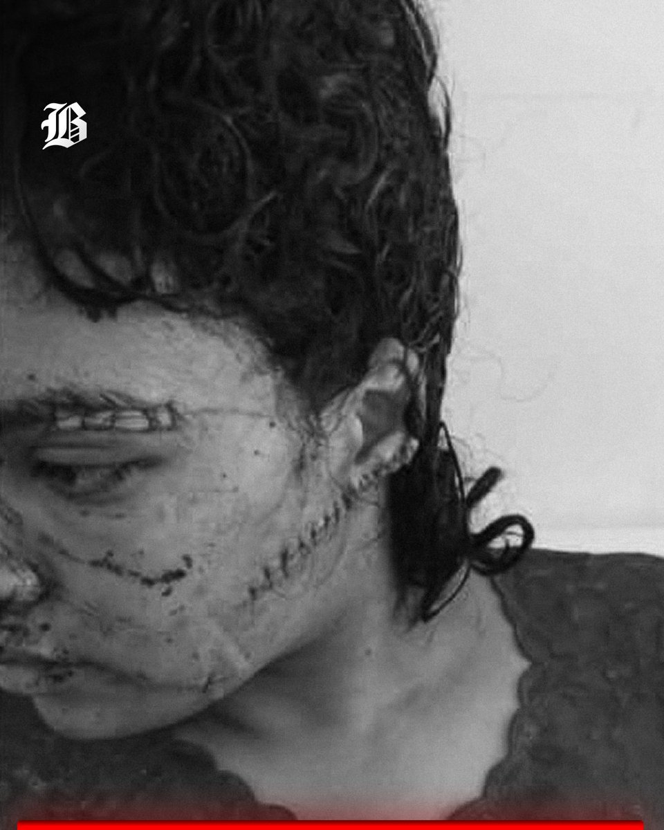 BarlamanToday's tweet image. A 25-year-old Moroccan woman, identified by her family as Imane, is recovering from a brutal attack by her former husband that has left her with more than 130 stitches to her face. 

#Morocco #Taza