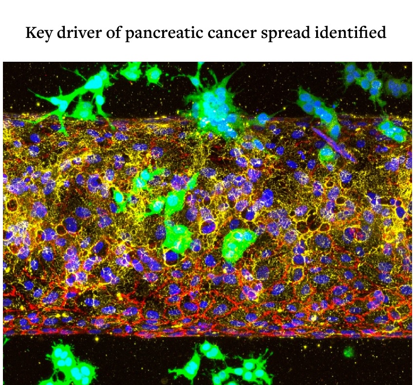 Dr Singularity (@dr_singularity) on Twitter photo Huge cancer Breakthrough
Key driver of pancreatic cancer spread identified
Scientists at Cornell have discovered how pancreatic ductal adenocarcinoma, one of the deadliest cancers, spreads through the body, and how to stop it.
They found that a receptor called ALK7 helps Huge cancer Breakthrough
Key driver of pancreatic cancer spread identified
Scientists at Cornell have discovered how pancreatic ductal adenocarcinoma, one of the deadliest cancers, spreads through the body, and how to stop it.
They found that a receptor called ALK7 helps