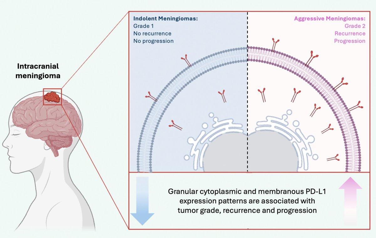🧠Don't let this pass you by!
ORIGINAL ARTICLE -  Wiley Online Library
PD‐L1 expression pattern as predictive factor of biological behaviour in intracranial meningiomas:
A single‐center retrospective study
🔗doi.org/10.1111/eci.70…
✍️GabrieleGaggero  AlessandroPesaresi