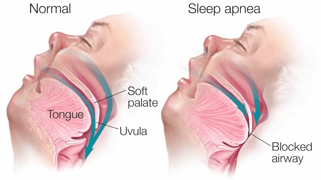 You sleep 8 hours every day, but still wake up tired.

Coffee, napping, and exercising don’t help...your energy is always at zero.

Hundreds of millions suffer from sleep apnea, and 80% don't even notice.

Here’s what’s going on (and how to fix it):