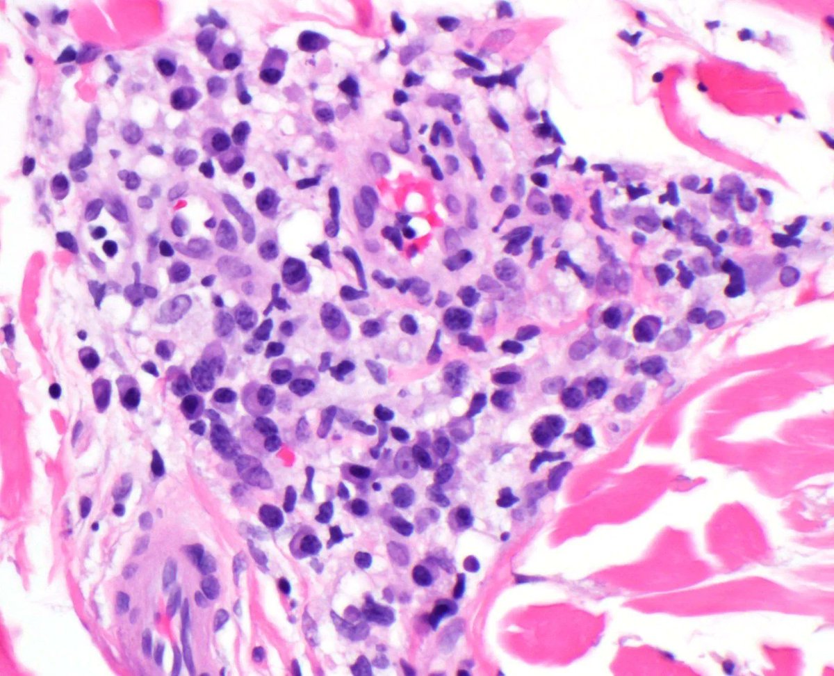 Erythematous macules on trunk of 30 yo man. Your diagnosis? 
Answer &amp; video here: youtube.com/watch?v=F5PcnZ… 
You must have high index of suspicion for this in #dermpath...most cases won't be so classic! #pathology #pathologists #pathTwitter #dermatology #dermatologia #dermtwitter