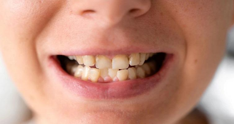 otexeworld's tweet photo. 🦷 Primary tooth trauma boosts the risk of permanent tooth defects 7-fold. Intrusion, avulsion, and lateral luxation in children aged 0–2 are especially risky. Early assessment and follow-up are key to prevention. https://t.co/UqmRMuNBS0